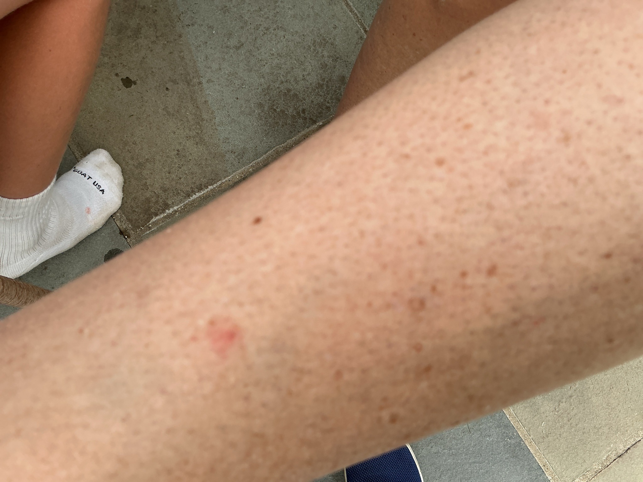 Human Skin with Irritation